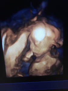 Baby_20-week ultrasound